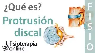 Protrusión discal subligamentosa. ¿Qué es?