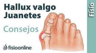 Hallux Valgus o juanete. Consejos y tratamiento con ejercicios, auto masajes y estiramientos