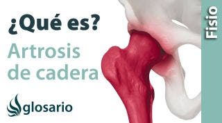 ARTROSIS DE CADERA | ¿Qué es?