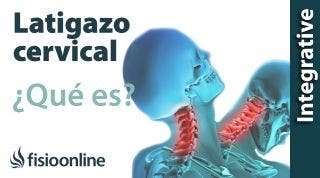 Latigazo cervical ¿qué es y cuáles son las claves de su solución?