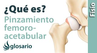 PINZAMIENTO FEMOROACETABULAR | ¿Qué es?