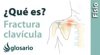 FRACTURA DE CLAVÍCULA | ¿Qué es?