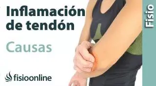Tendinitis - Como sucede y Cuales son sus causas.