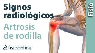 Artrosis de rodilla. Signos radiológicos.