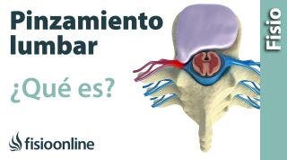 Pinzamiento lumbar. ¿Qué es?