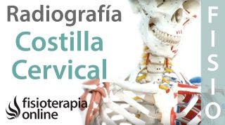 Costilla cervical - Qué es y cómo se diagnostica por radiografía