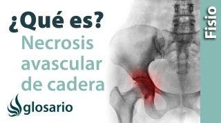 NECROSIS AVASCULAR EN LA CADERA | ¿Qué es?