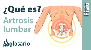 ARTROSIS LUMBAR | ¿Qué es?