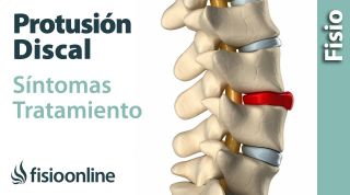 52# Protrusión de disco o discal. Qué es, causas, síntomas y tratamiento.