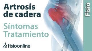 8# Artrosis o desgaste de cadera. Qué es, causas, síntomas y tratamiento.