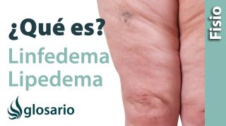 LINFEDEMA Y LIPEDEMA | ¿Qué son?