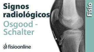 Enfermedad de Osgood-Schlatter o Crecederas. Signos radiológicos.