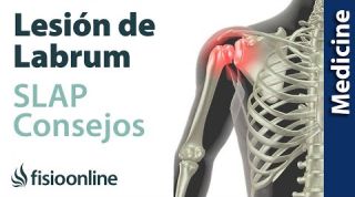 Consejos para solucionar la lesión labrum de hombro