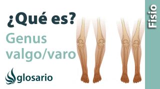 VALGO Y VARO DE RODILLA | ¿Qué es?