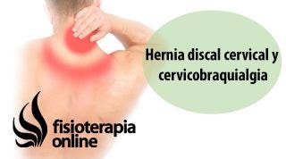 Hernia discal cervical y cérvico-braquialgia.