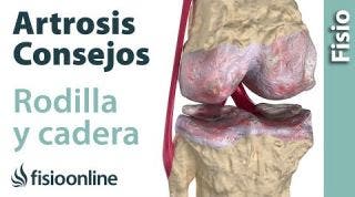 Artrosis de rodilla o de cadera. Cosas que debes saber.