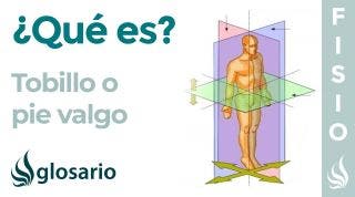PIE VALGO | Qué es, causas, síntomas, a quién afecta y tratamiento