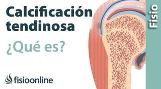 38 Calcificación tendinosa. Qué es, causas, síntomas y tratamiento.