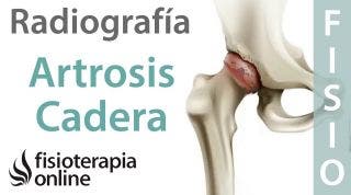 Artrosis de cadera - Qué es y cómo se diagnostica en radiografías
