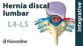 Hernia discal lumbar entre la L4 y L5 o cuarta y quinta vértebras lumbares