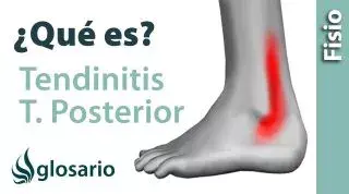 TENDINITIS DEL TIBIAL POSTERIOR | ¿Qué es?