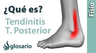TENDINITIS DEL TIBIAL POSTERIOR | ¿Qué es?