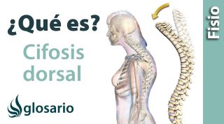 CIFOSIS DORSAL | ¿Qué es?