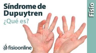 14# Síndrome o enfermedad de Dupuytren. Qué es, causas, síntomas y tratamiento.