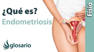 ENDOMETRIOSIS | ¿Qué es?