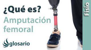 AMPUTACIÓN FEMORAL | ¿Qué es?