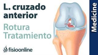 Lo que necesitas saber sobre la Rotura del Ligamento cruzado anterior (LCA)