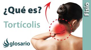 TORTÍCOLIS | ¿Qué es?