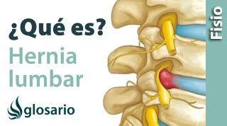 HERNIA DISCAL LUMBAR | ¿Qué es?