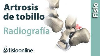 Artrosis de tobillo - Qué es y cómo se diagnostica en radiografías