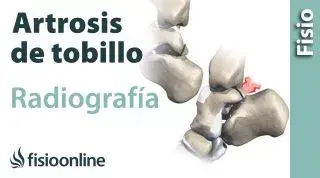Artrosis de tobillo - Qué es y cómo se diagnostica en radiografías