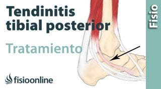 Tendinitis del tibial posterior