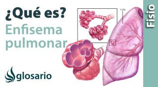 ENFISEMA PULMONAR | Qué es, qué estructuras afecta, síntomas, signos, causas y tratamiento