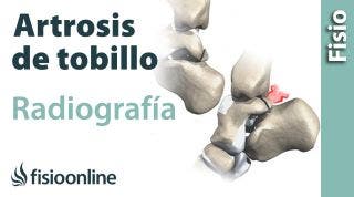 Artrosis de tobillo - Qué es y cómo se diagnostica en radiografías
