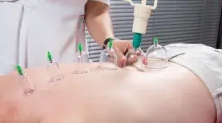 La técnica de Cupping o Ventosas, ¿Tiene verdaderos efectos o es un placebo?