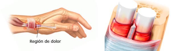 Diagnóstico de la Tendinitis De Quervain 