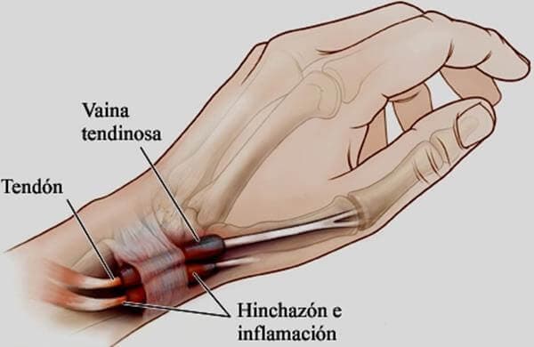 Tendinitis de Quervain Archivos