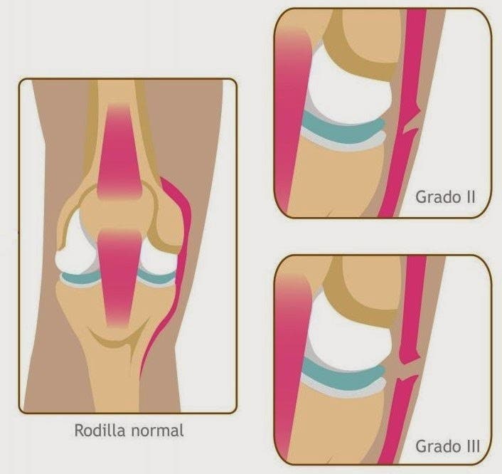 Tiempo de recuperación del esguince de rodilla