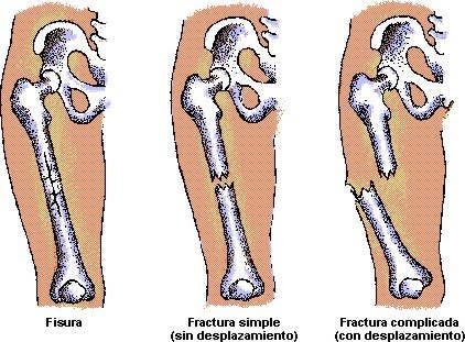 fisura de hueso