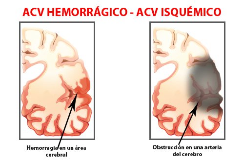 tipos de acv