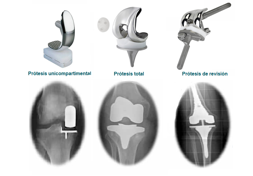 Tipos de prótesis de rodilla
