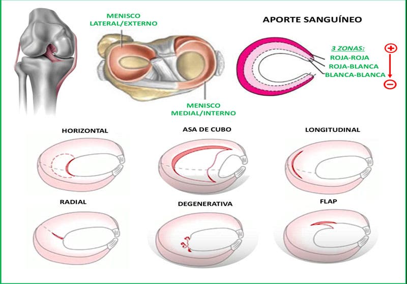 tipos de roturas de menisco