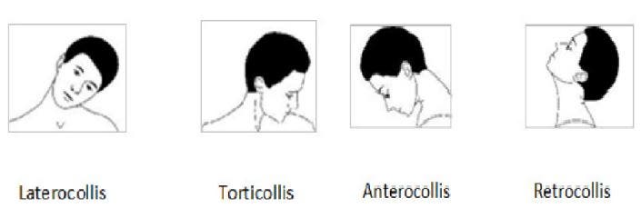 Tipos de tortícolis según la posición de la cabeza
