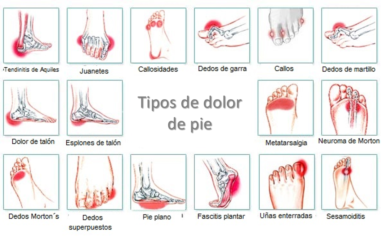 Tipos de dolor de pies
