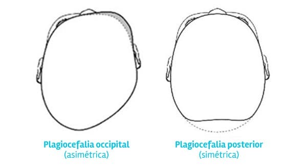 Tipos de plagiocefalia