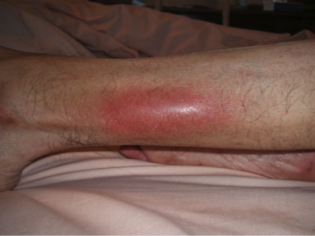 phlebitis-treatment-pain-leg